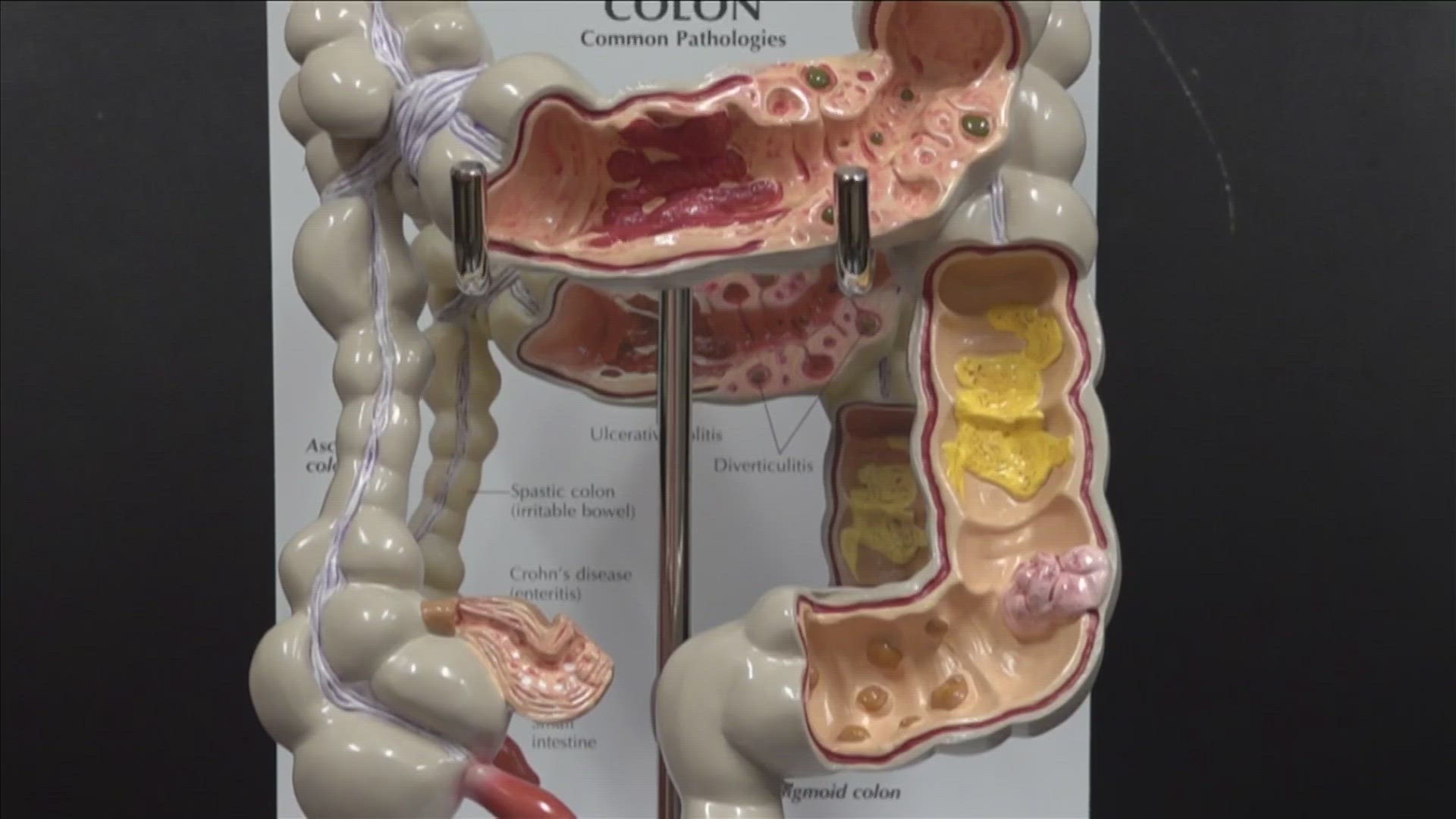 March is Colorectal Cancer Awareness Month. Doctors recommend people get screened for colon cancer after turning 45.