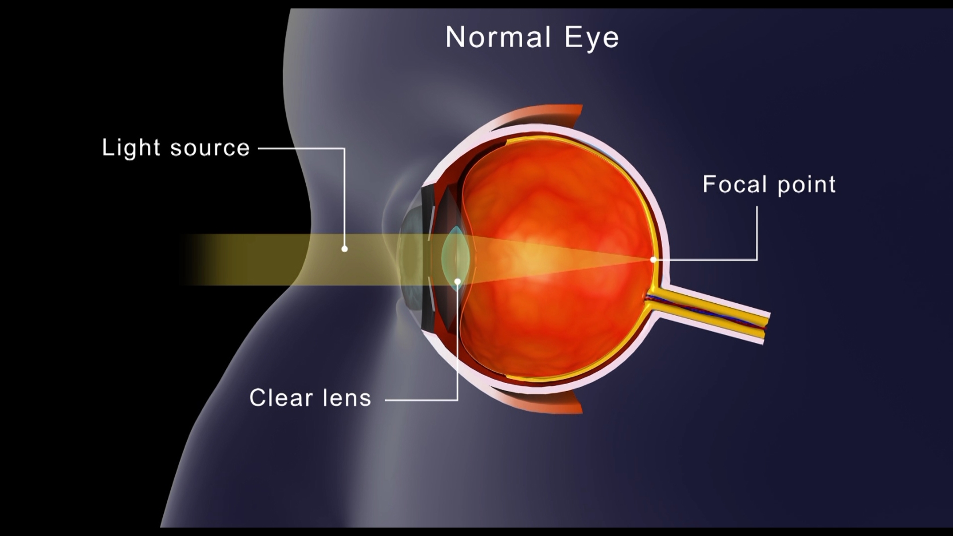 Dr. Toyos explains how easy it is to correct your eyes.