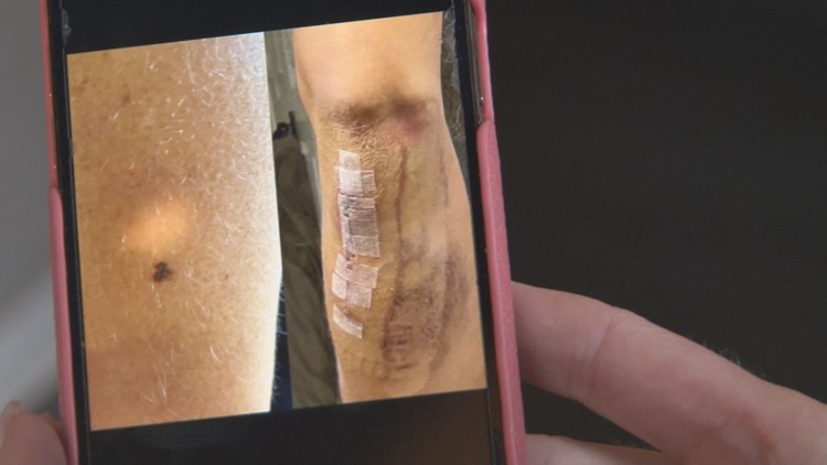 Skin cancer cases on the rise as summer sun shows up