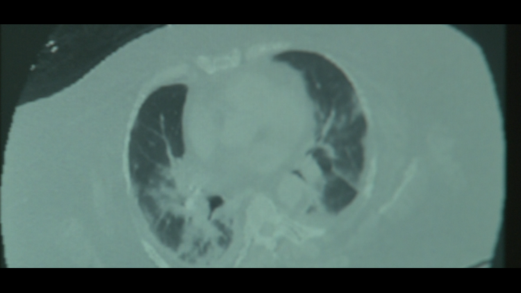 Doctor en &aacute;rea Este de TN indica que pacientes pueden experimentar efectos a largo plazo en los pulmones a ra&iacute;z del COVID-19