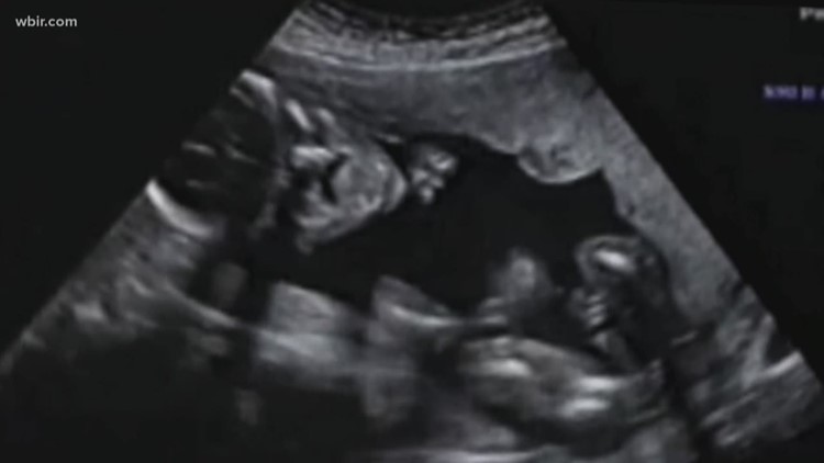 Some doctors concerned over abortion ban implications