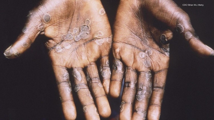 What you should know about monkeypox, vaccine