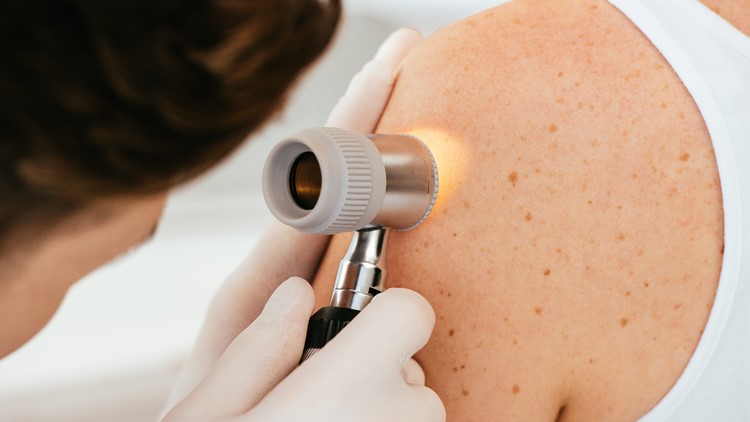 UT Medical Center gives tips for spotting melanoma