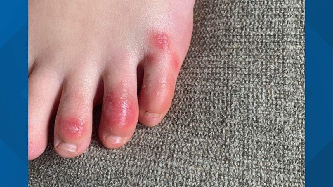 What are 'COVID toes'? New skin condition possibly linked to