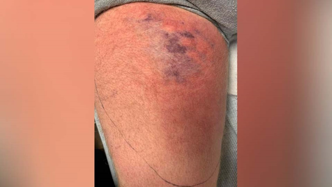 Alabama man hospitalized with flesh-eating bacteria after kayaking in ...