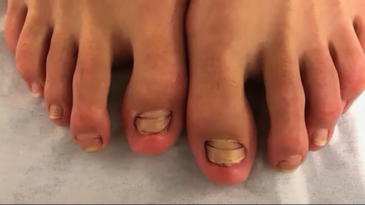 Woman lost her toenails after fish pedicure