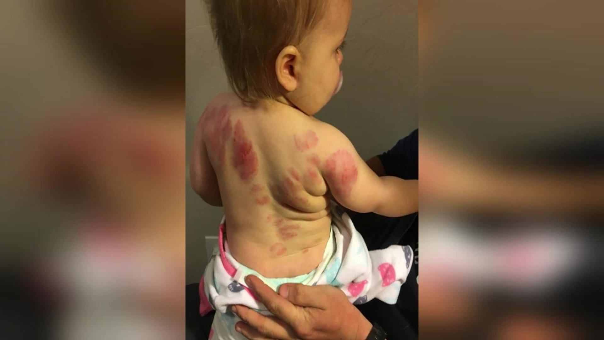 Mom Says Her Daughter Was Bitten 25 Times At Her Daycare 10tv Com