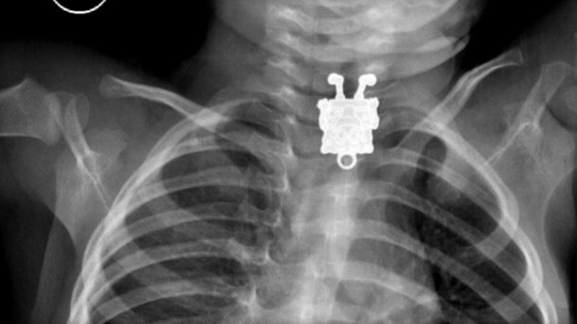 XRay Photos Child Swallows SpongeBob SquarePants