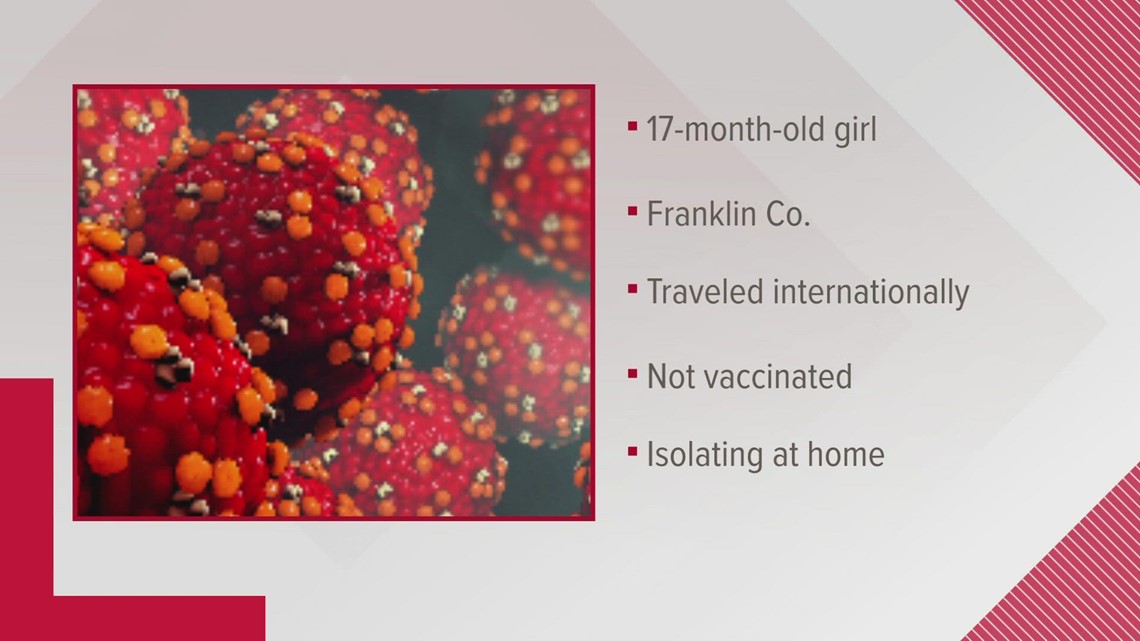 Ohio's 1st case of measles since 2019 confirmed in Franklin County 17-month-old