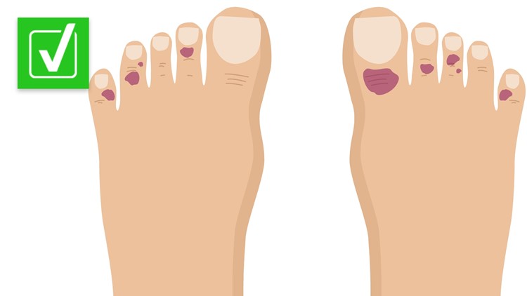 Yes, COVID toes are a real condition