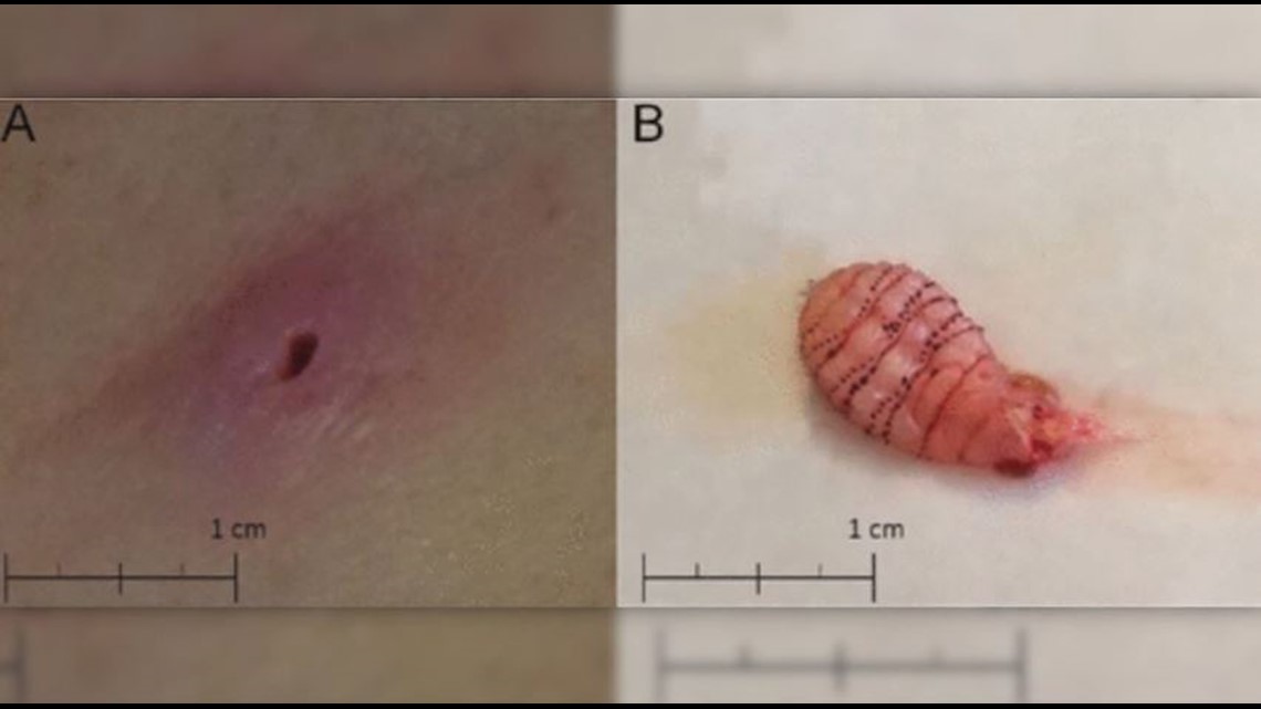 Woman finds maggot living under her skin after returning from honeymoon