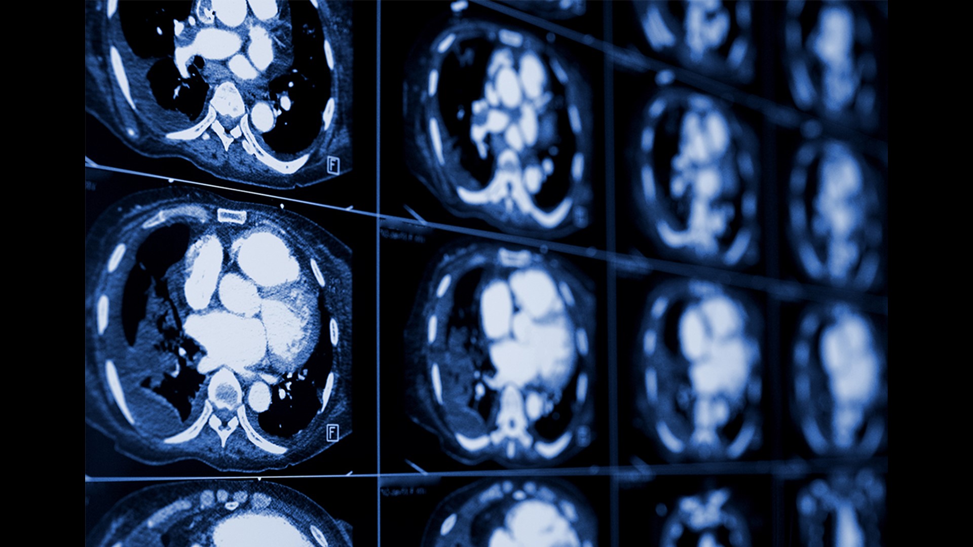 New Lung Cancer Screening Guidelines Could Save Lives | 10tv.com