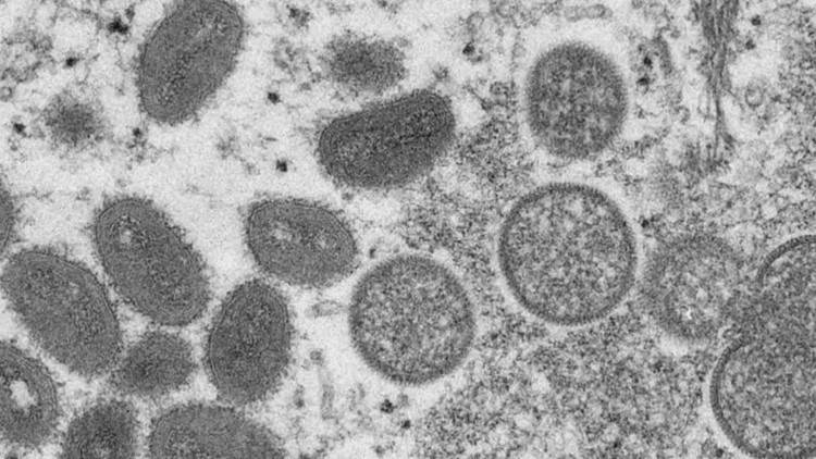 Autoridades de salud confirman primer caso de viruela símica en México