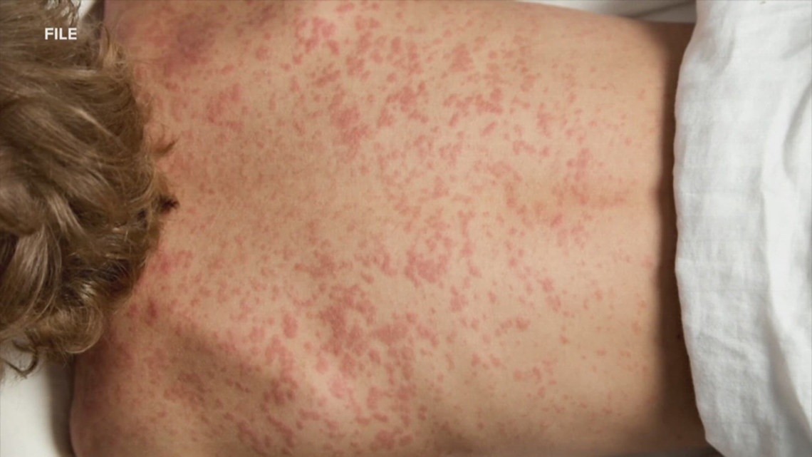 Alabama State Health Officer: ‘Fully expect’ to see measles in the state