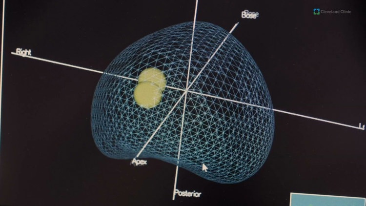 AI helps diagnose prostate cancer, but can it answer parents' health questions?