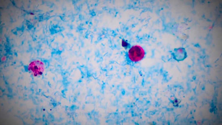 Cyclosporiasis linked to 2 deaths in Michigan