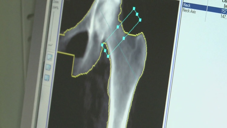 Bone density, Ozempic generics, cortisol myths, and hangxiety. Here are today's health headlines