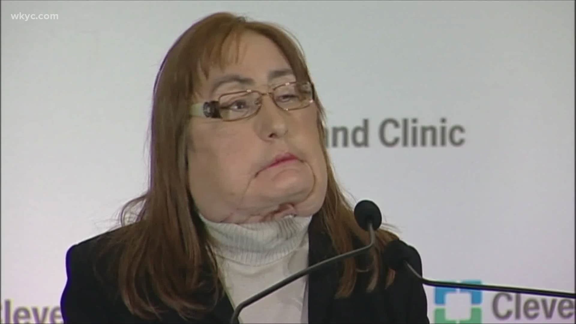Culp died on Thursday at the age of 57. She received the face transplant in 2008.