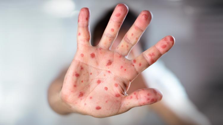 5 more measles cases confirmed in Wayne County, with an additional 29 cases 'suspected or probable'