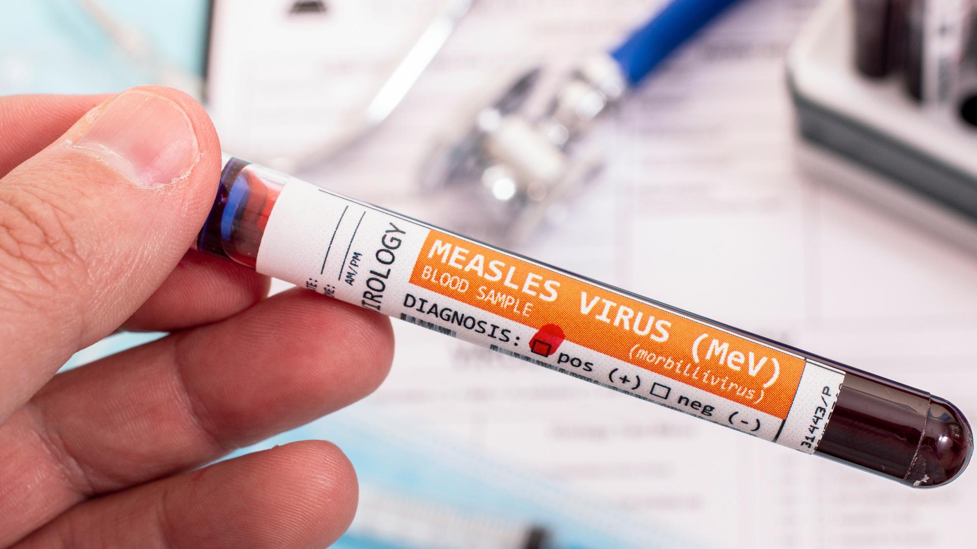 Ohio declares third measles outbreak of 2026 after 4 linked cases in northeast counties