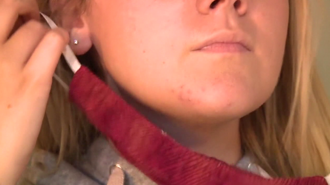 Can face masks give you acne?