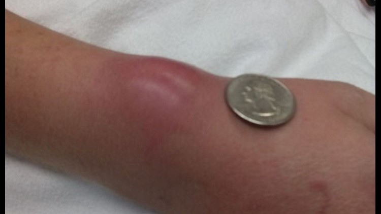 Woman Develops Potentially Deadly Infection After Wearing Hair