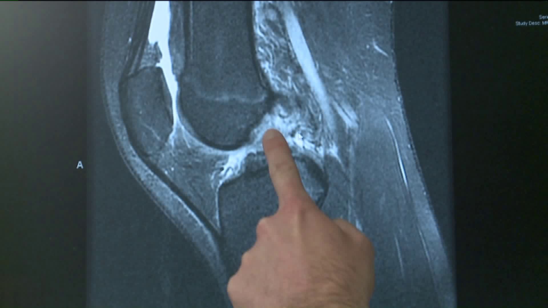 'I felt the whole thing pop'  Women and Knee Injuries