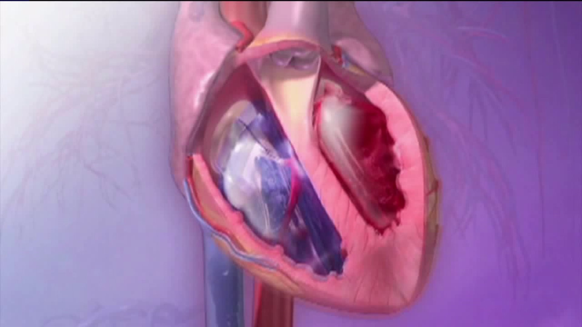 Healthwatch 16: Heart Murmurs