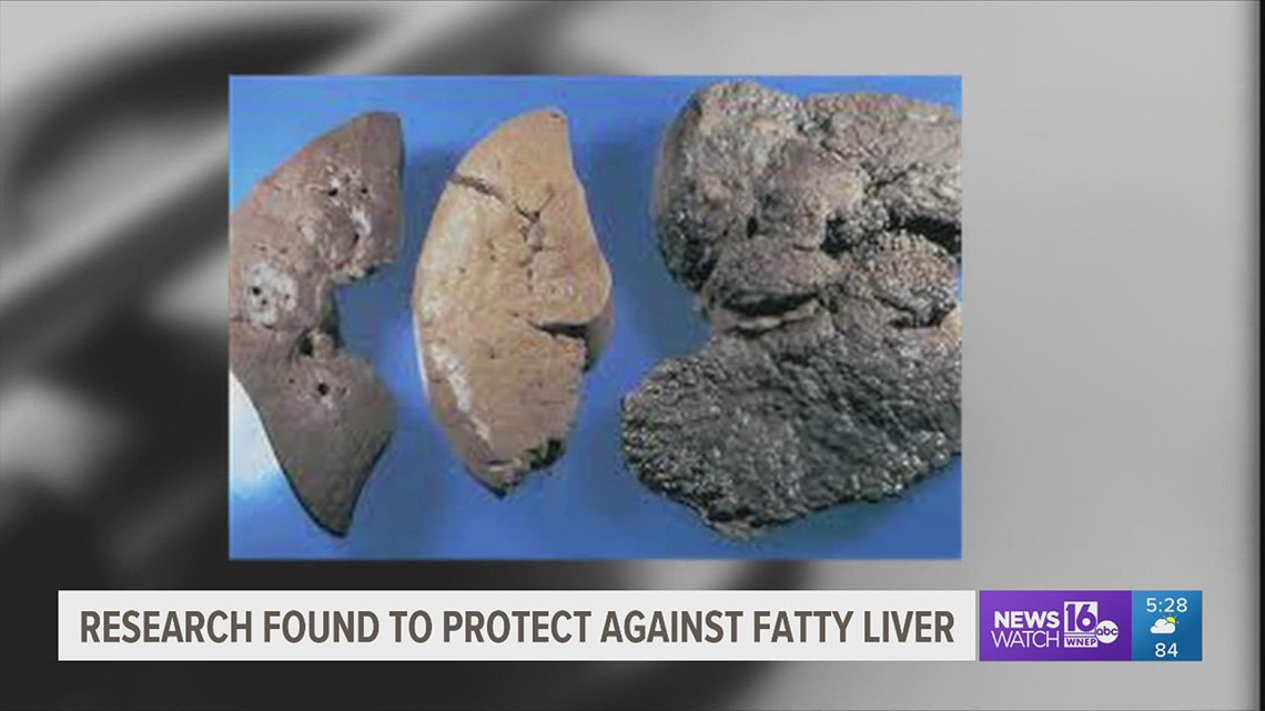 Healthwatch 16: Researchers helped discover genetic changes to protect against liver disease