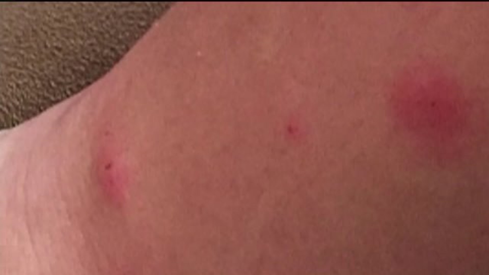 Bed Bugs Hit Wilkes University Dorm