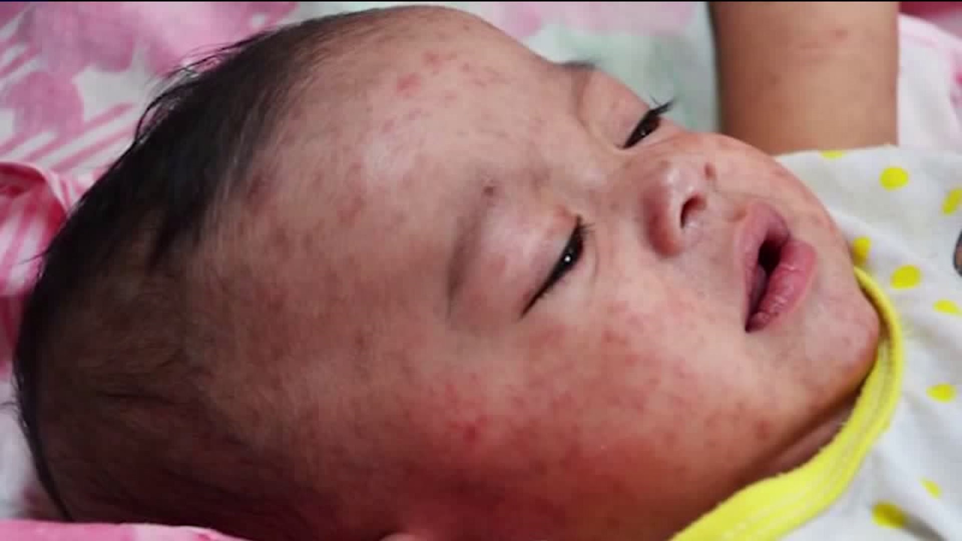 Area Doctors Monitoring Measles Outbreak