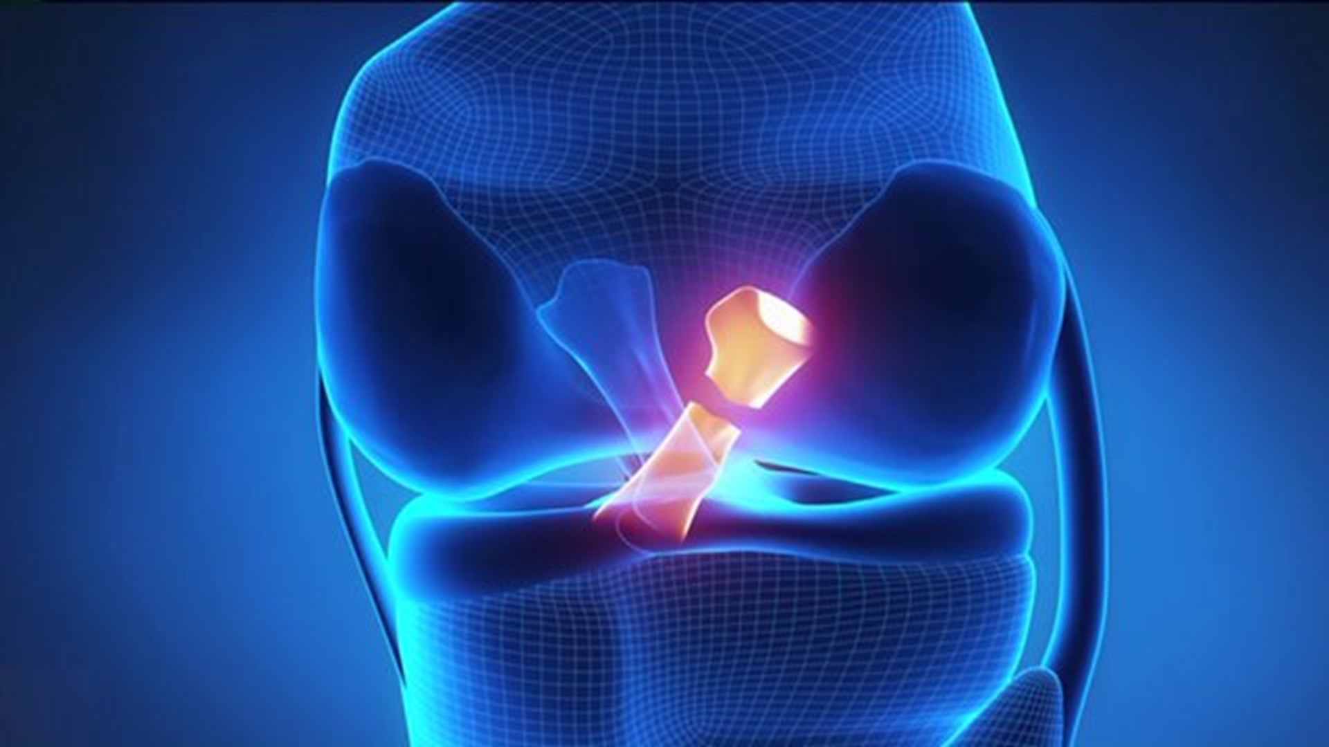 Playing It Safe: ACL Injury Prevention
