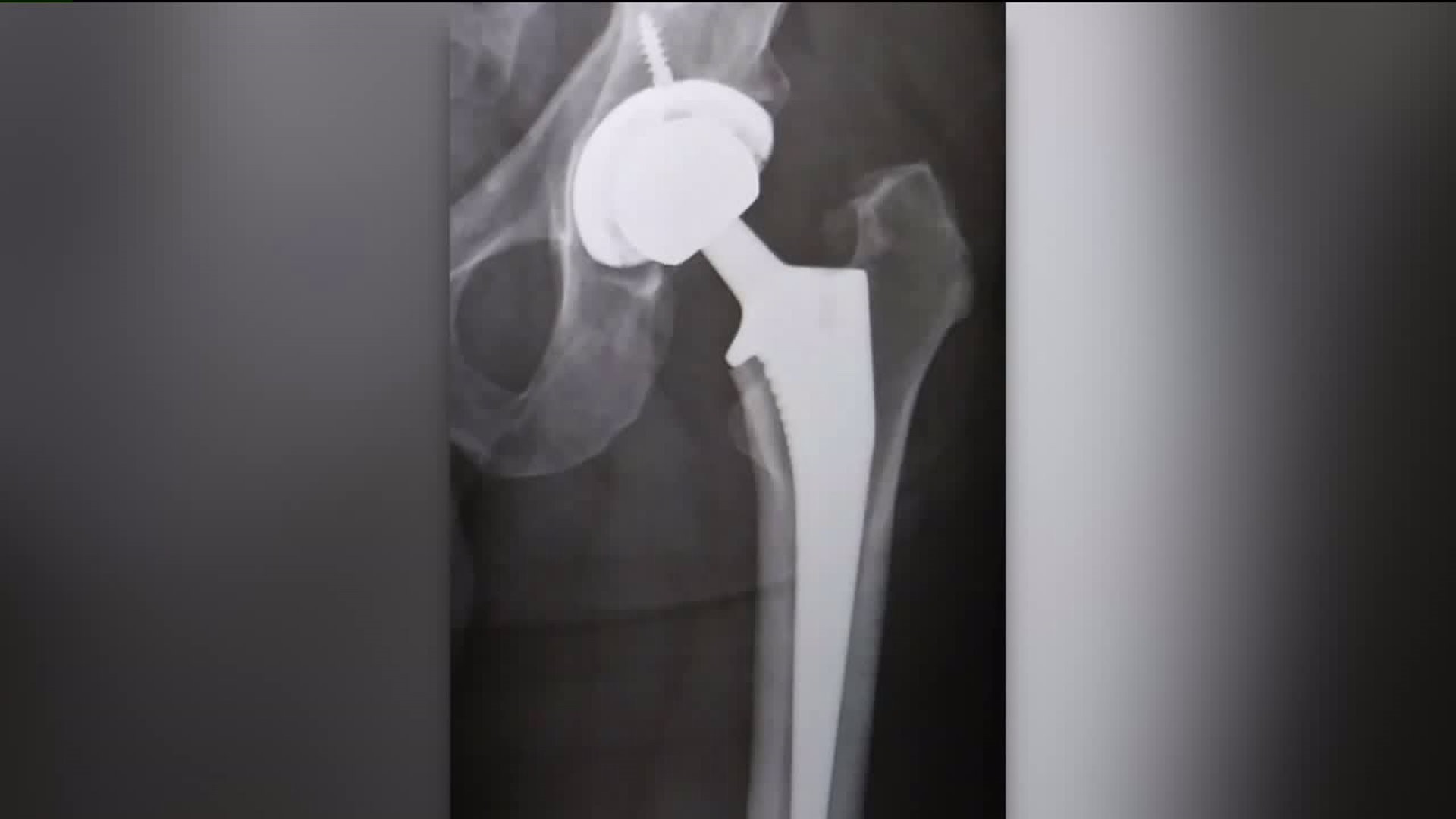 Healthwatch 16: New Hip Replacement Option