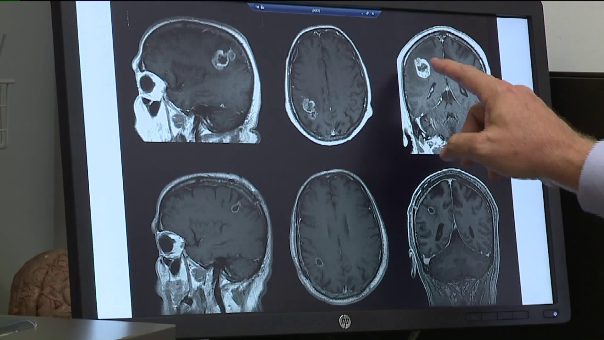 Device Helping Brain Tumor Patients