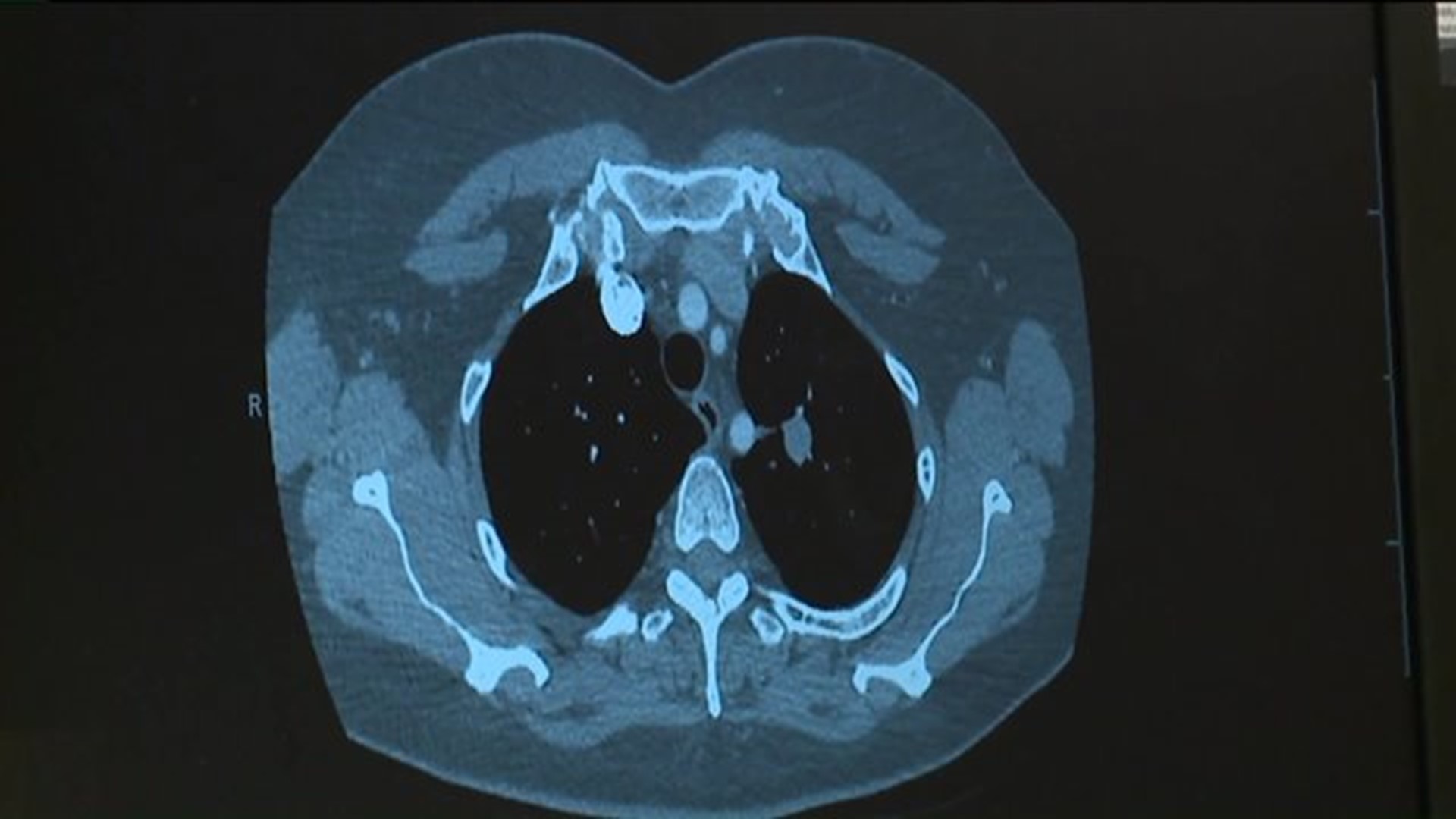 Healthwatch 16: Lung Cancer in Nonsmokers