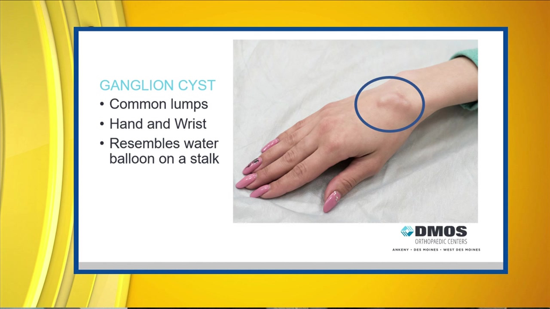 Orthopaedic Minute What Is A Ganglion Cyst