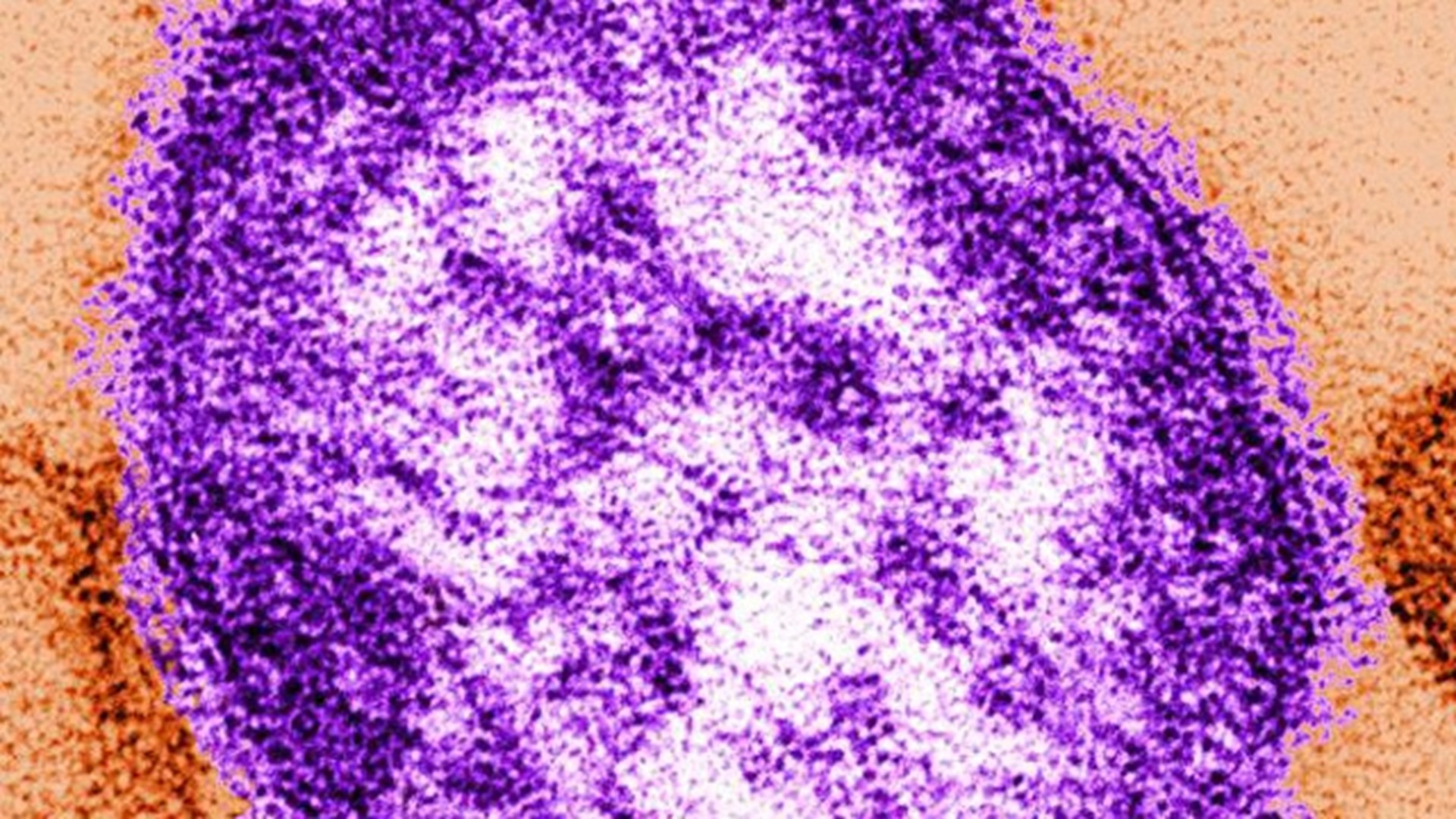 The measles outbreak is now confirmed in at least 15 states, with new cases in Vermont, Maryland, and Oklahoma.