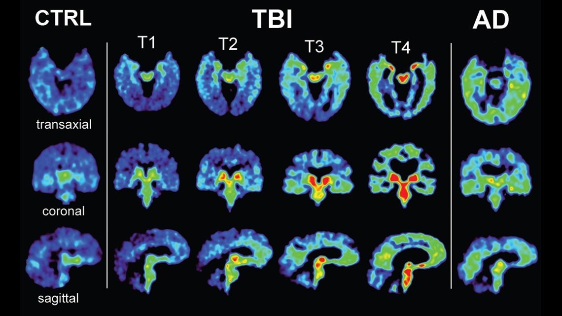 CTE Was Found in 99 Percent of Brains That NFL Players Donated to Science