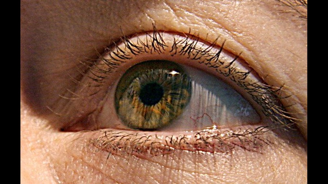 Eyelash Lice Yes, It’s Real