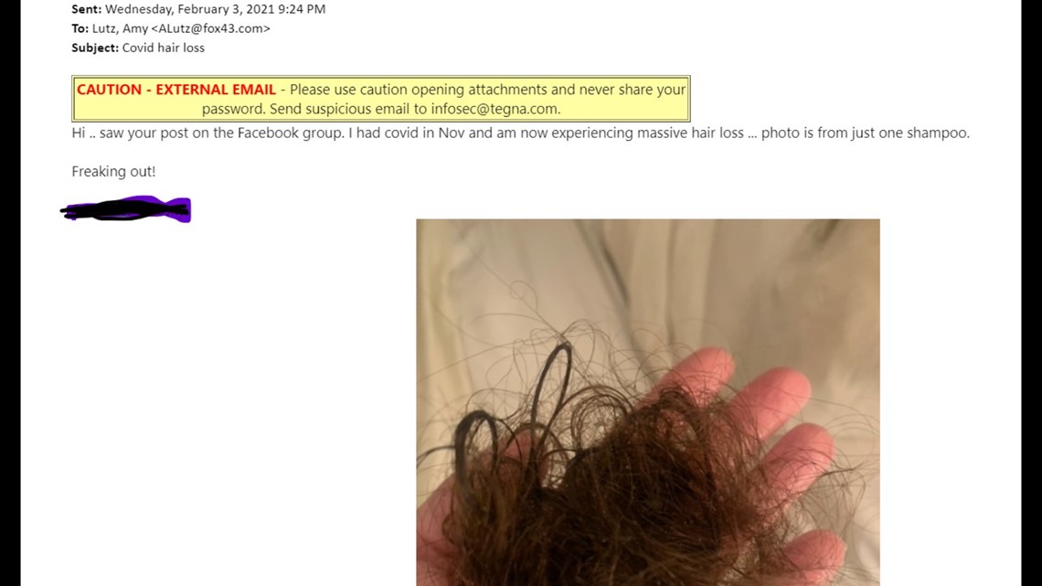 hair loss after covid vaccine pfizer