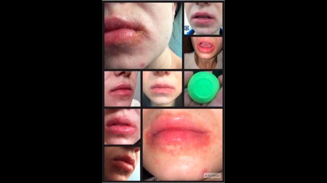 EOS lip balm caused blisters, rash, lawsuit claims