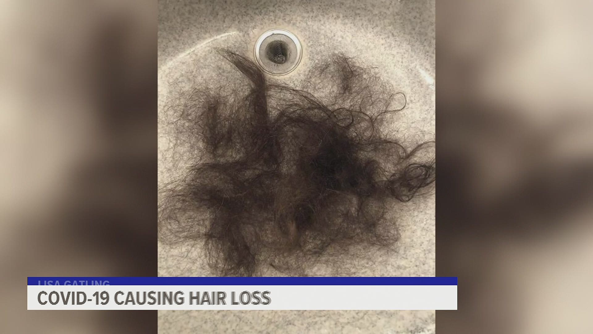 COVID-19 is causing hair loss: Here's why 