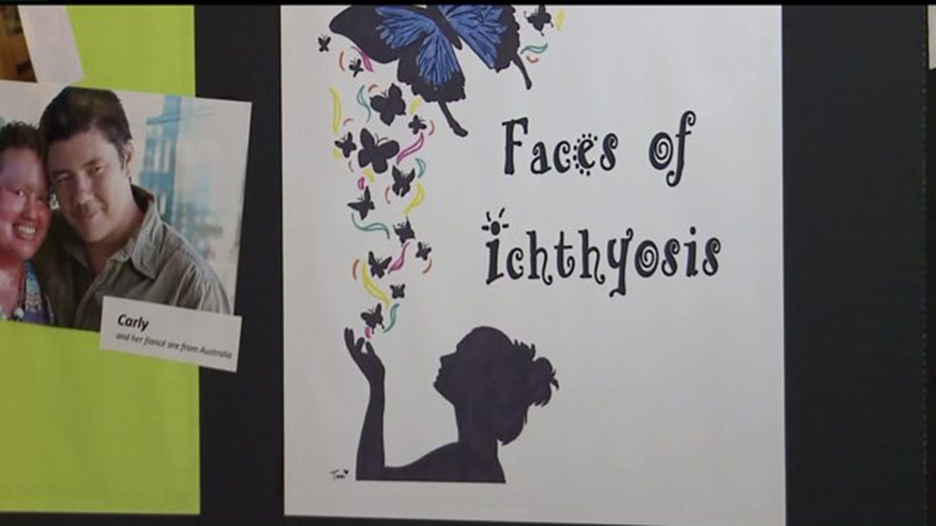 Community supports girl with rare genetic skin disorder