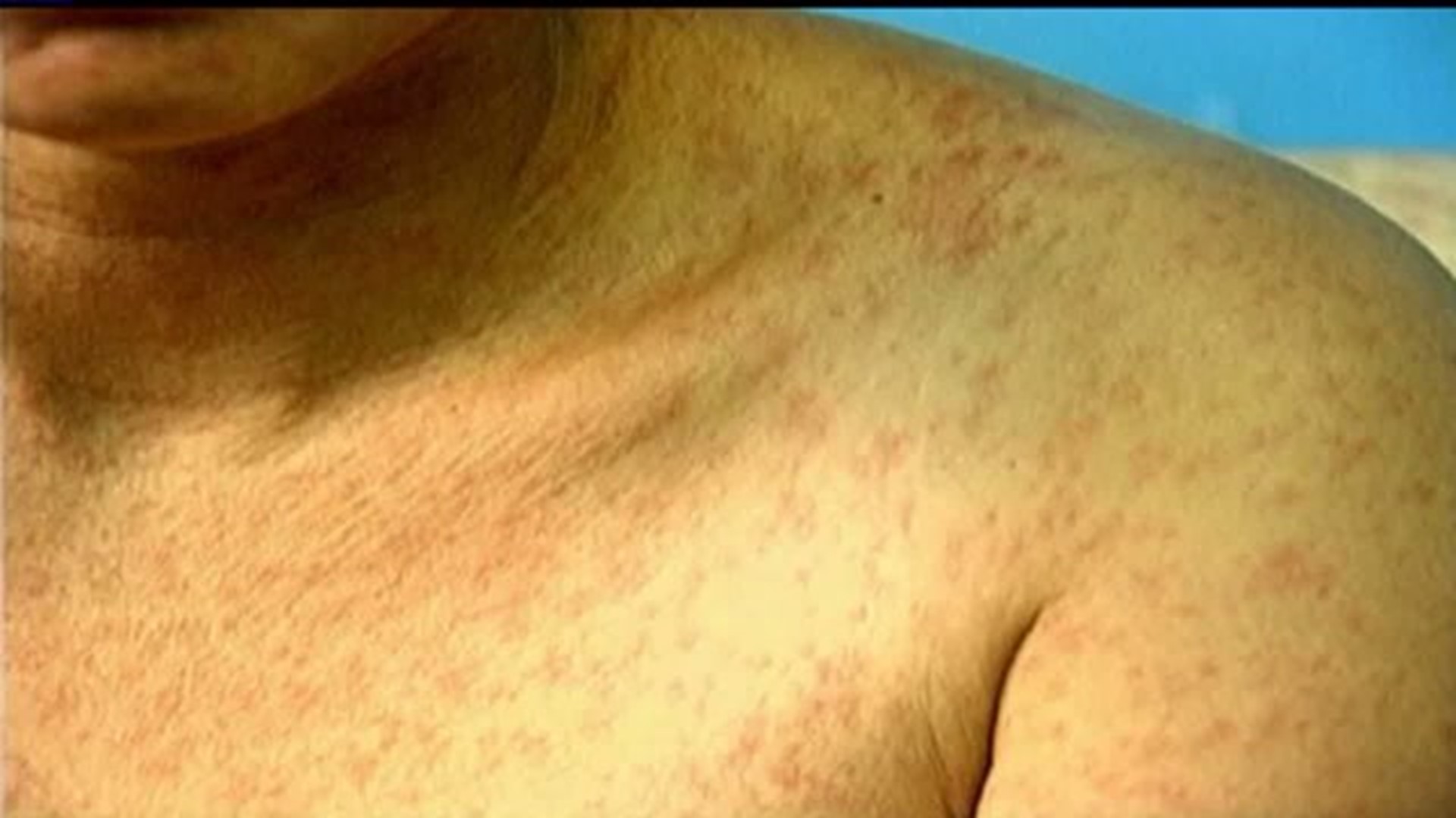 Possible measles exposure in Cumberland and Franklin counties