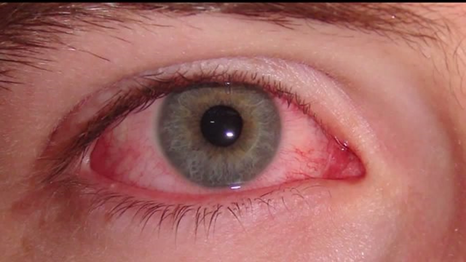 Pink eye can be a pesky ailment among children