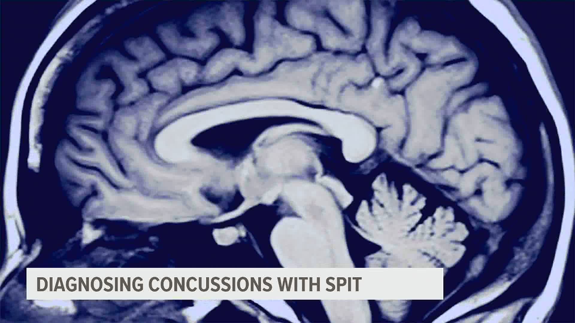 Penn State researchers said a spit test may be able to diagnose a concussion and predict how long symptoms will last.