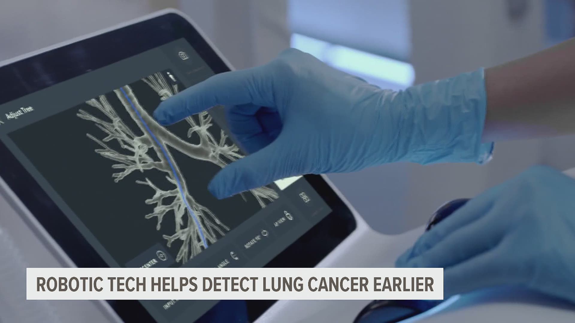 More than 90% of people diagnosed with lung cancer don't survive because it's found too late.