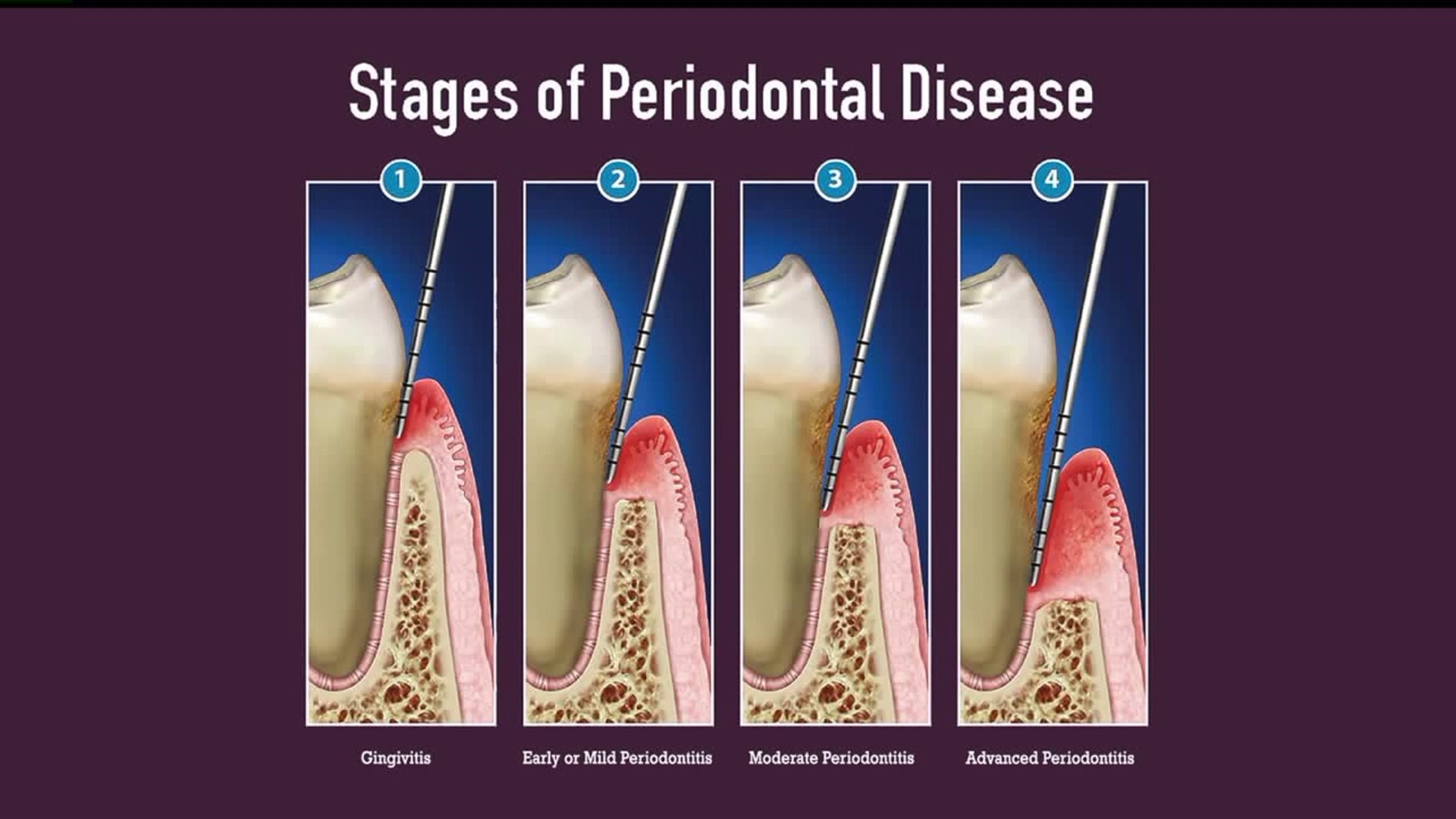 Periodontal disease affects over 64 million Americans