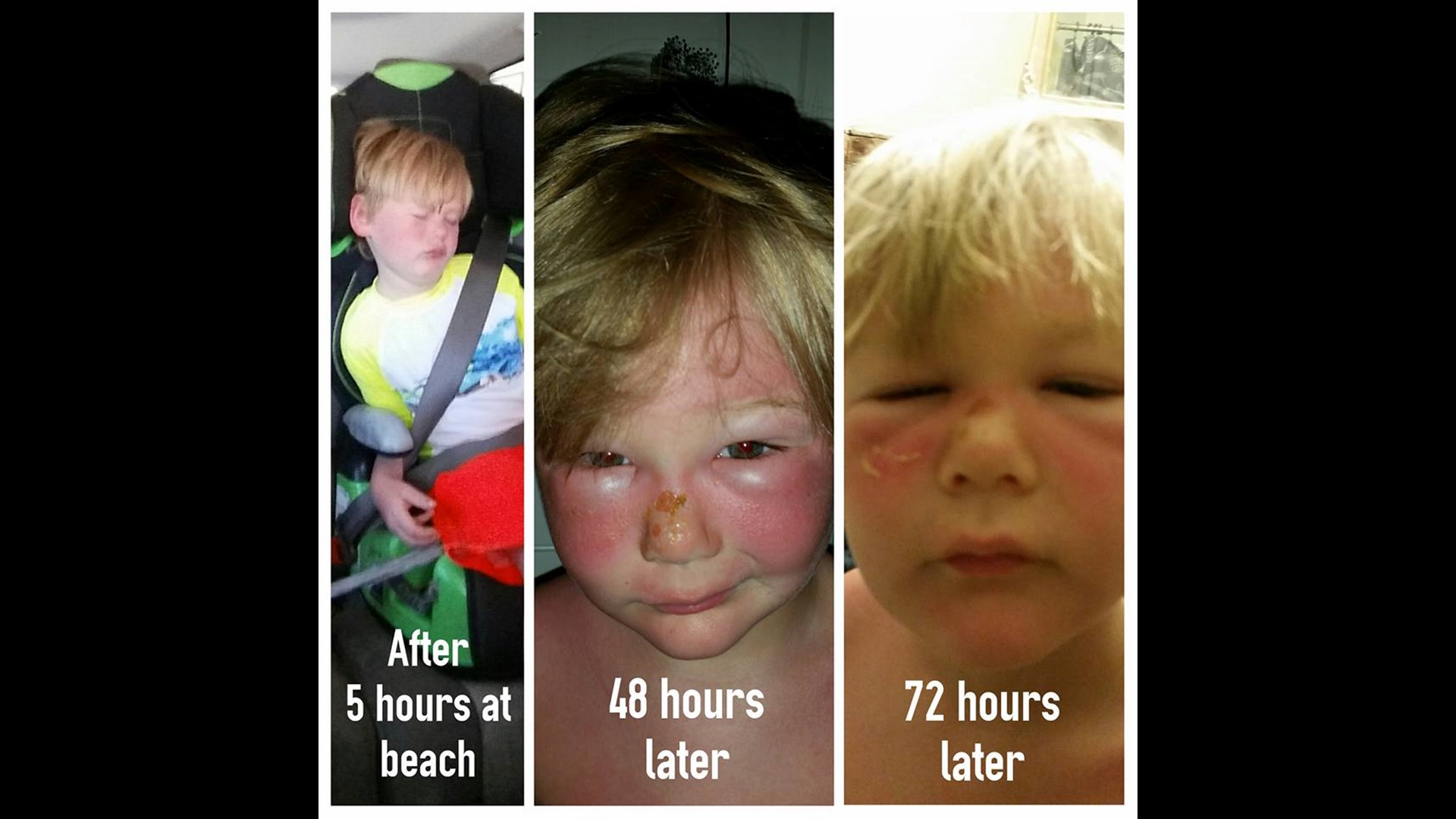 Boy suffers second degree burns even after applying 50 SPF sunscreen