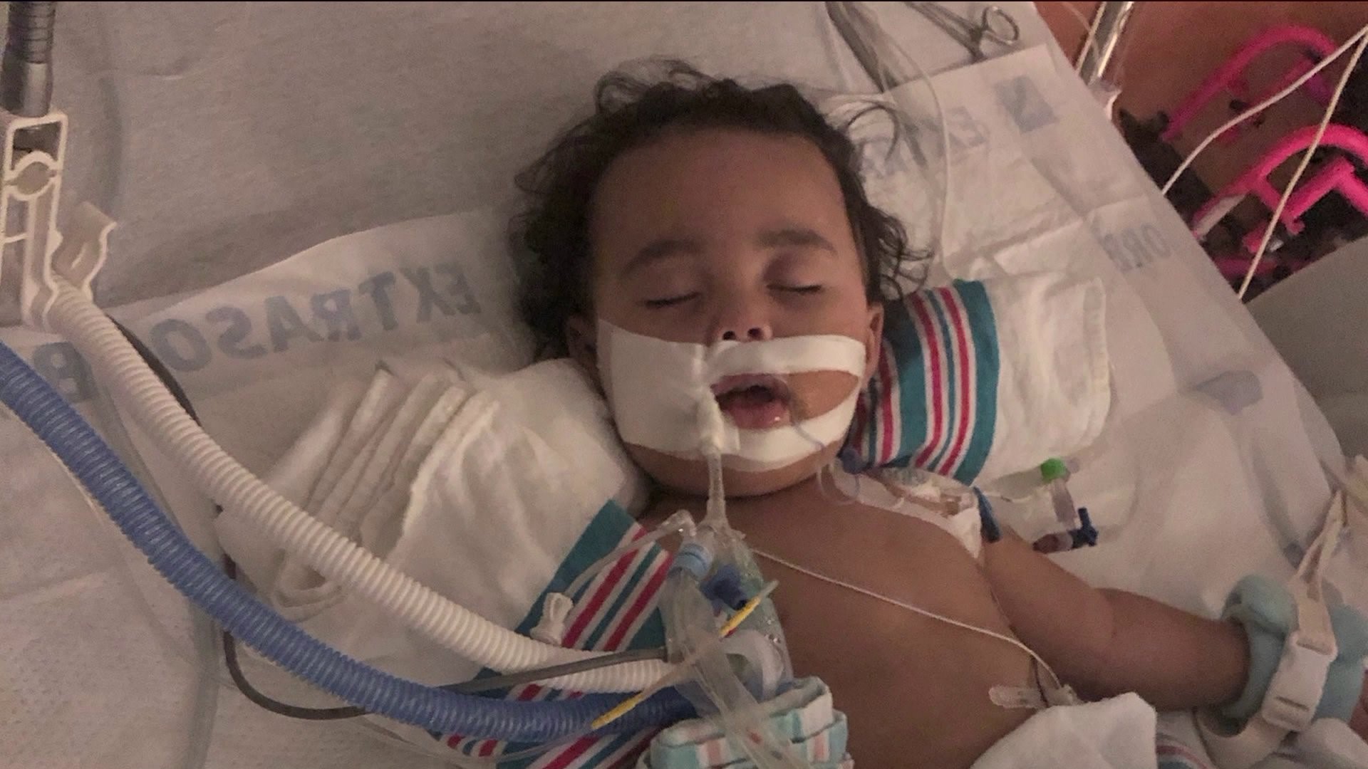 Swallowed button battery burns hole in toddler’s esophagus